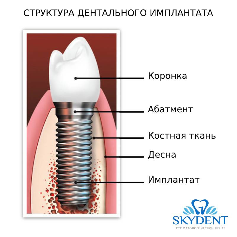 Схема имплантации зубов